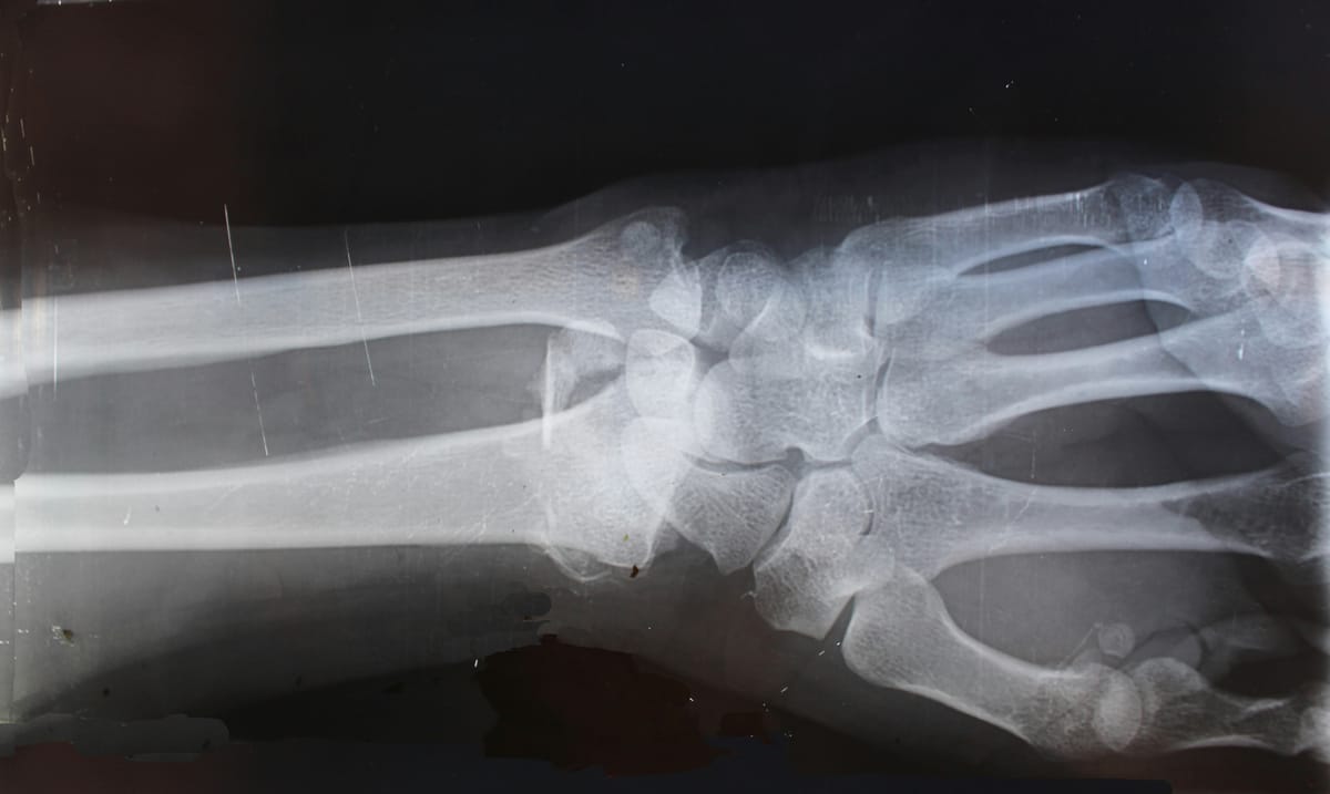 Injured arm in a cast illustrating the difference between accident-only coverage and comprehensive health insurance for truck drivers